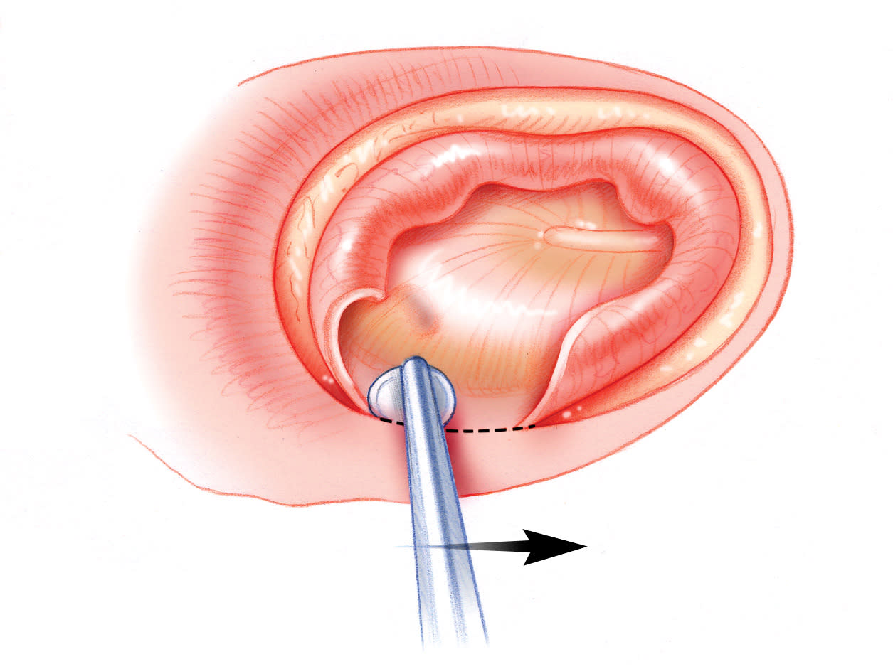 Cerebrospinal Fluid Leak | Jackler Collection | Volumes Cerebrospinal Fluid Leak | Jackler Collection | Volumes